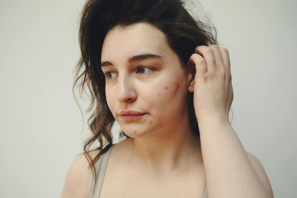 Cystic vs. Hormonal acne: What's the difference?