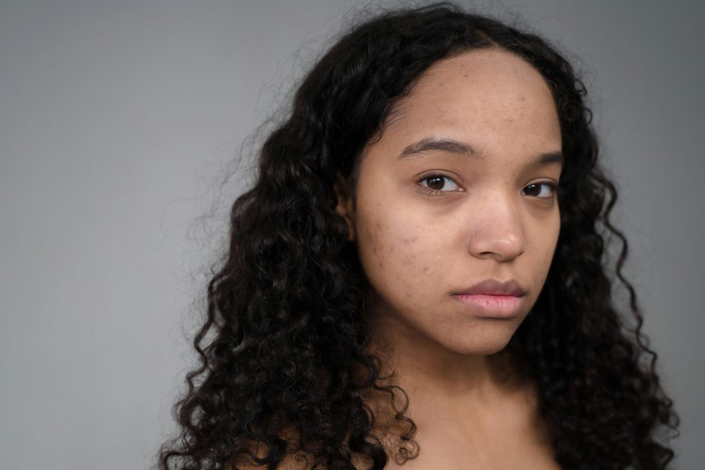How to get rid of acne scars fast