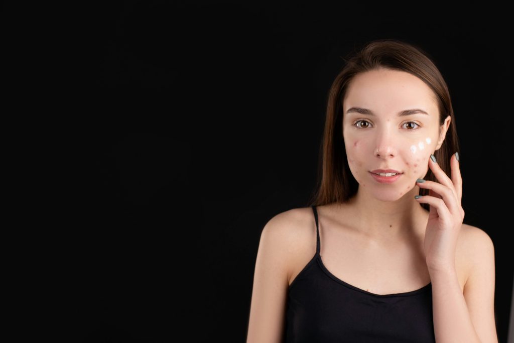 Best Moisturizers for Acne-Prone Skin | Top 10 Picks for Clear & Hydrated Skin